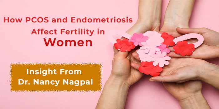 How PCOS and Endometriosis Affect Fertility